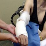 motorcycle injury Heterotopic-Ossification 1