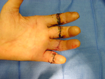 Stitches of hand