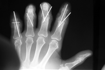 radiografía de la mano