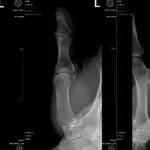 Radiografía de artritis de la articulación basal dr. cirujano de mano badia