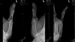 Radiografía de artritis de la articulación basal dr. cirujano de mano badia