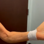 Honduran patient receives endoscopic surgery for carpal tunnel syndrome