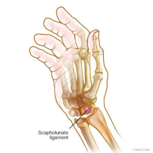 Wrist sprain and scapholunate tear affecting wrist ligaments illustrated.