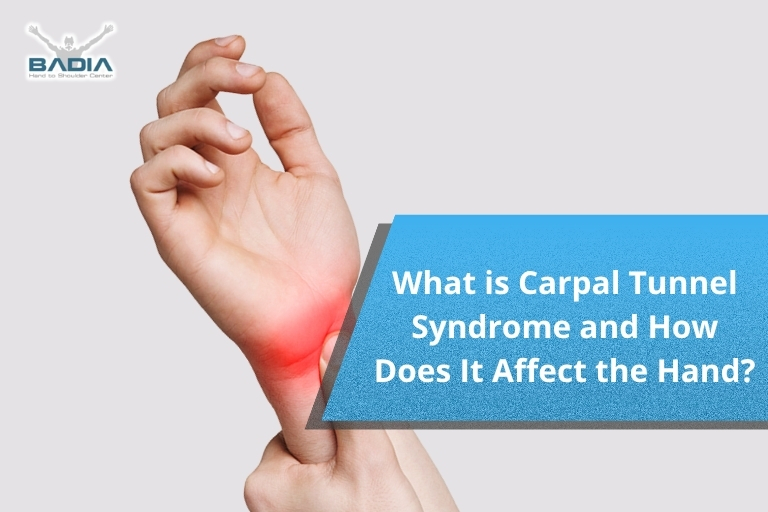 What is Carpal Tunnel Syndrome and How Does It Affect the Hand?