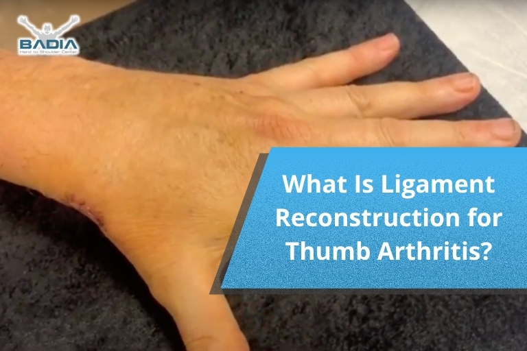 What Is Ligament Reconstruction for Thumb Arthritis?