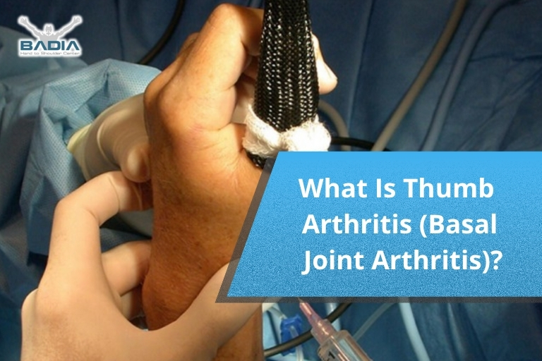 What Is Thumb Arthritis (Basal Joint Arthritis)?