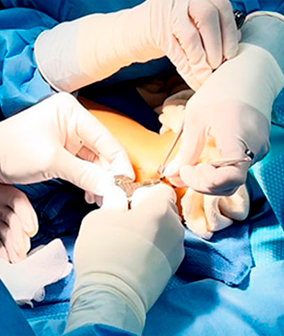 Cubital Tunnel Syndrome