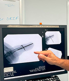 Mallet Finger