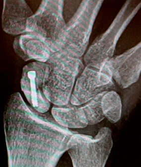 Scaphoid