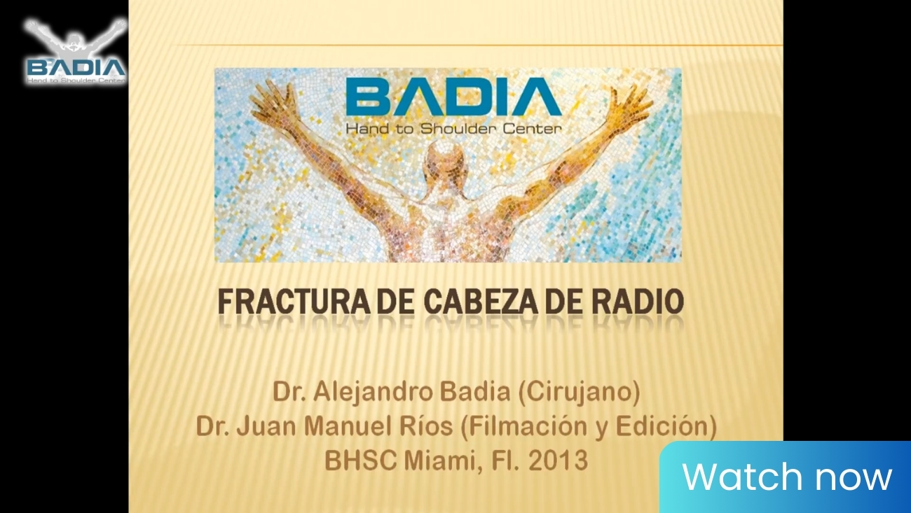 Fixation of Intra-articular Fracture of the Radial Head – Manson II Radius Head Fracture