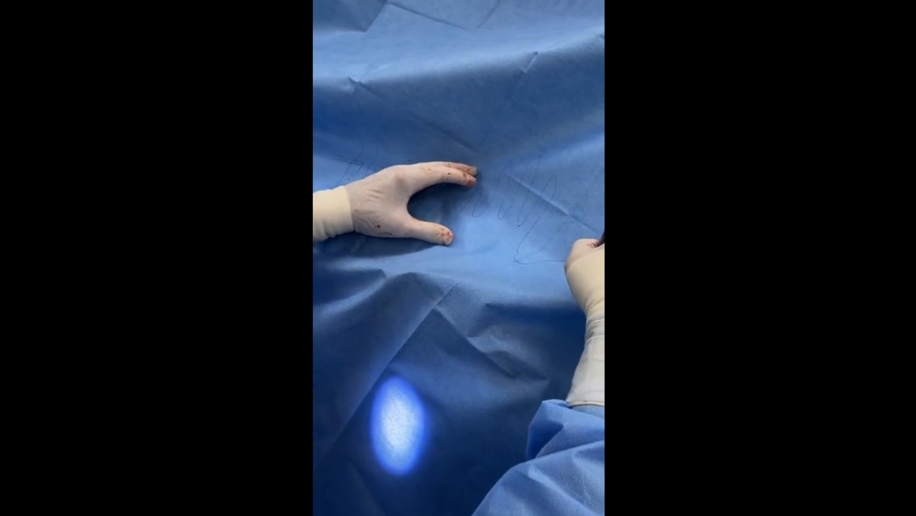 #LivesurgeryTuesday Recap: Tendon Transfer