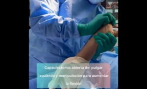 Paciente tiene rigidez en el pulgar y logra mover despues de una capsulectomia