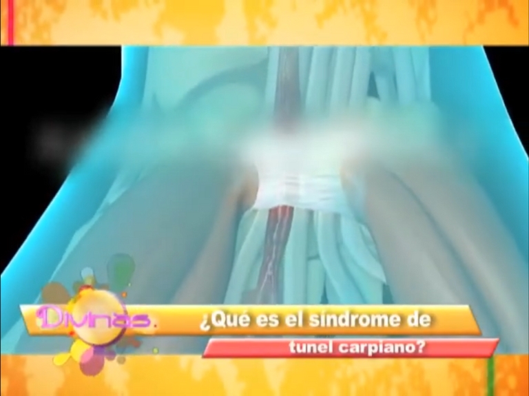 ¿Que es el síndrome de Túnel Carpiano?