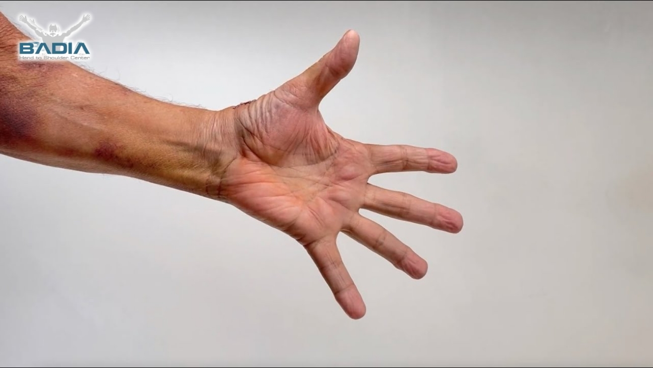 1 week after thumb surgery with the BioPro Modular Thumb