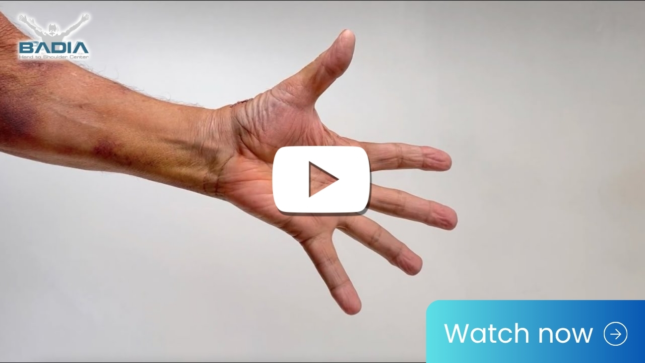 1 week after thumb surgery with the BioPro Modular Thumb