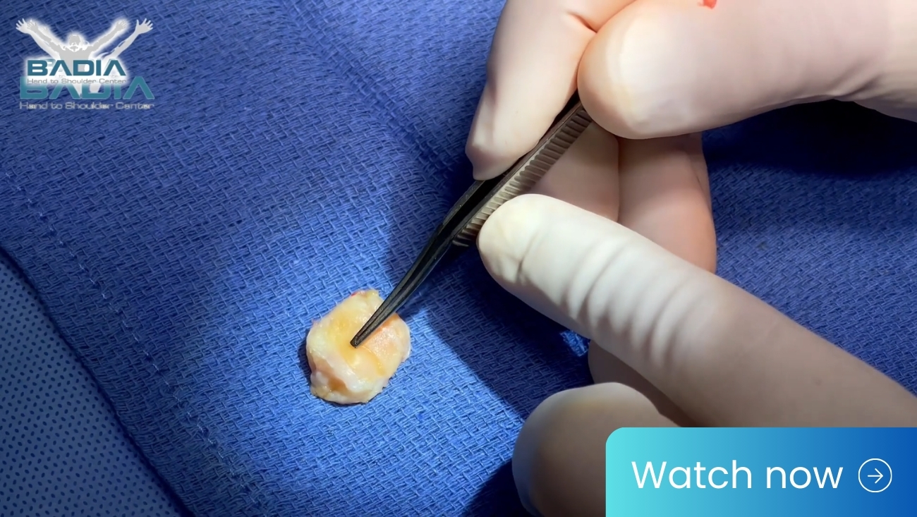 Arthritic CMC joint replaced by BioPRO prosthesis: Solution for base of the thumb arthritis