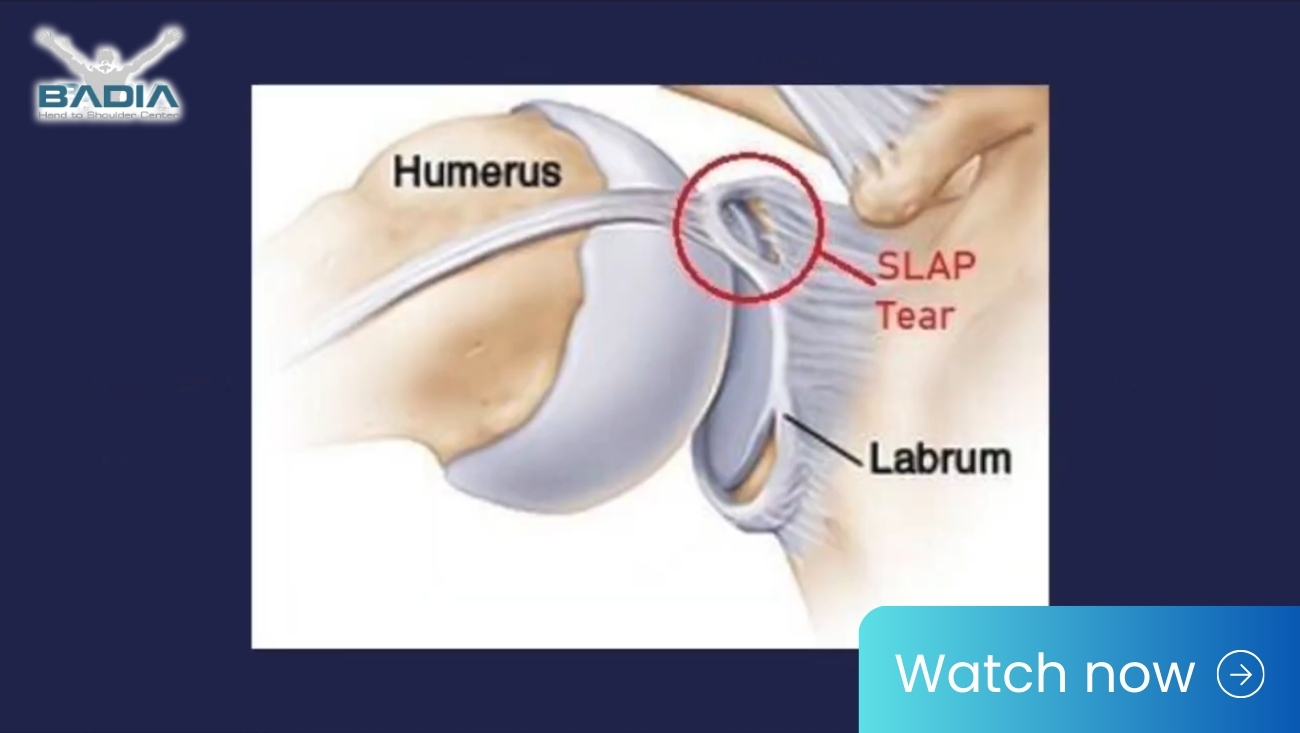 Arthroscopic SLAP (labral) repair