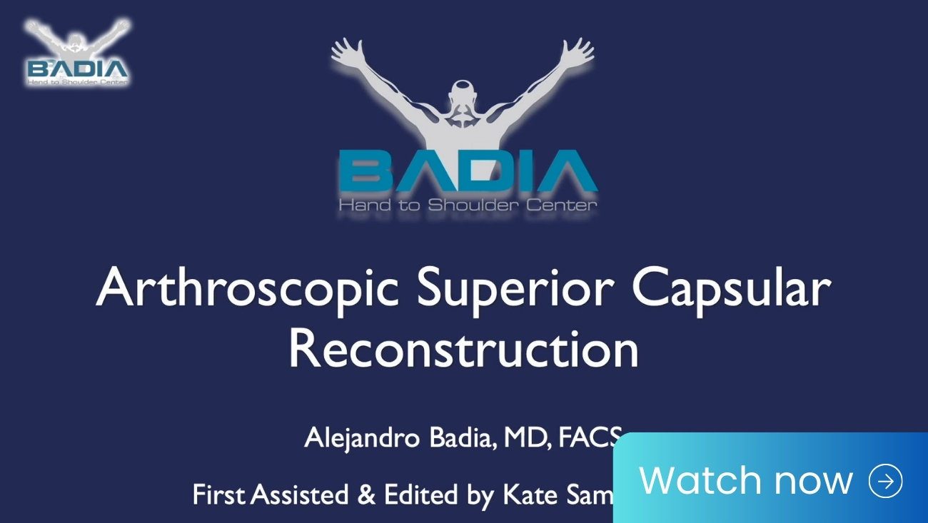 Arthroscopic superior capsular reconstruction for an irreparable rotator cuff tear