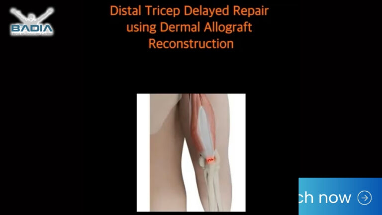 Dr Badia Performs a Distal Tricep Delayed Repair using Dermal Allograft Reconstruction