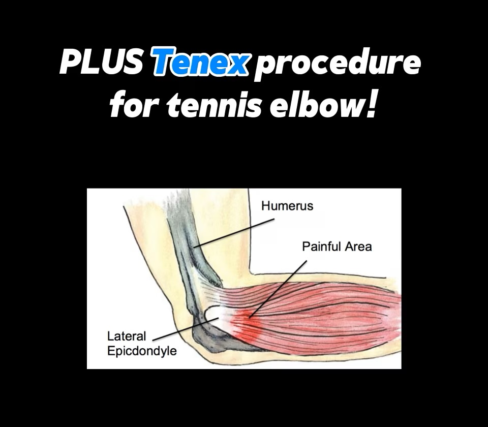 Elbow Arthroscopy