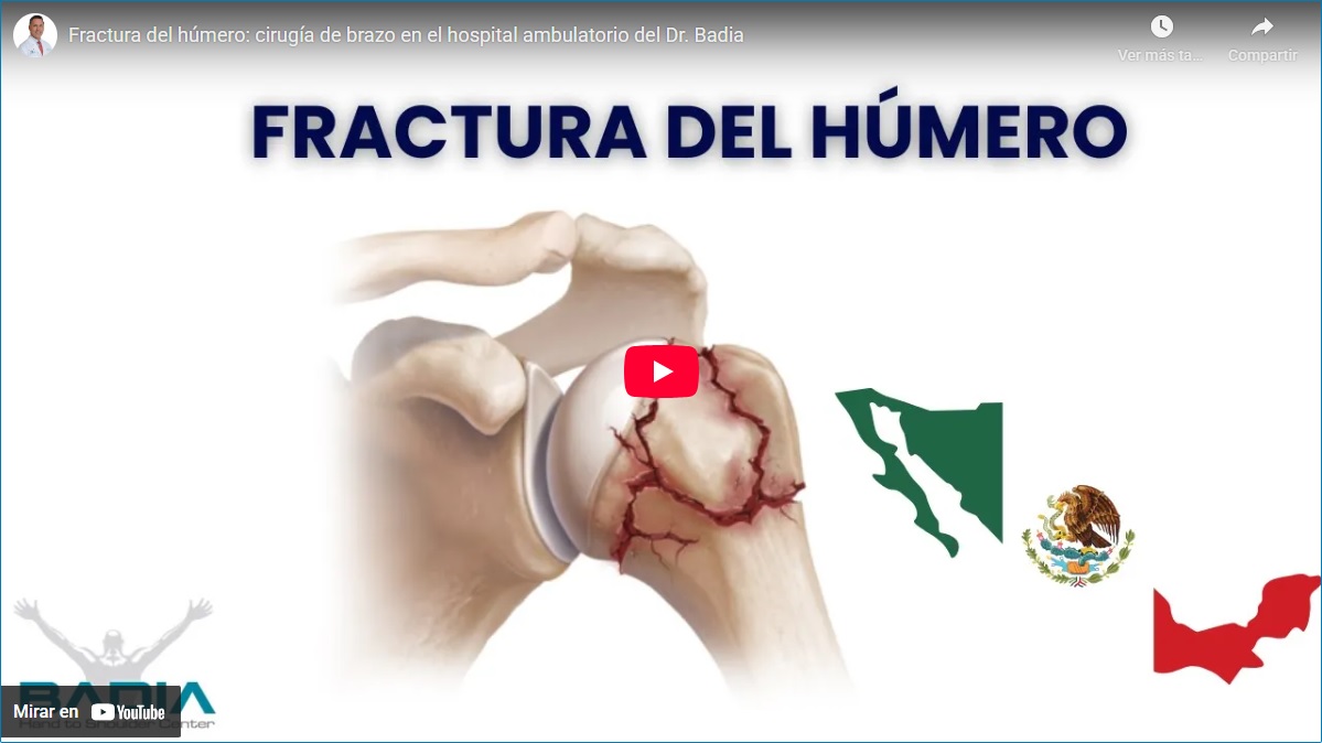 Testimonial: Humerus Fracture in a Patient from Mexico