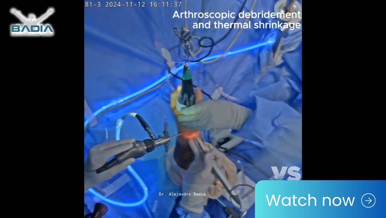 #LiveSurgeryTuesday Scapholunate Ligament Reconstruction