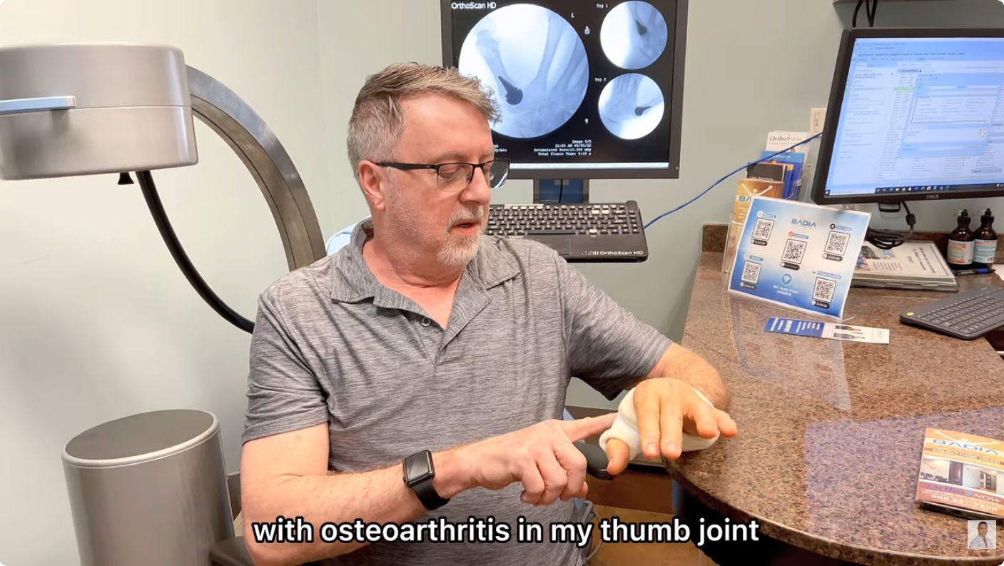 Patient refused traditional LRTI Procedure in GA & found a solution for basal joint arthritis in FL