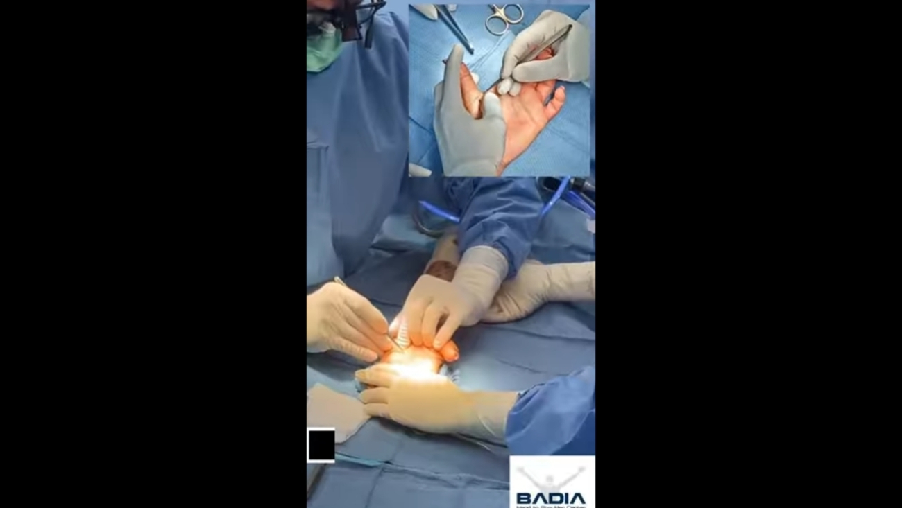 6 Surgeries in 30 Minutes: Trigger Finger, DeQuervain’s & Cubital Tunnel