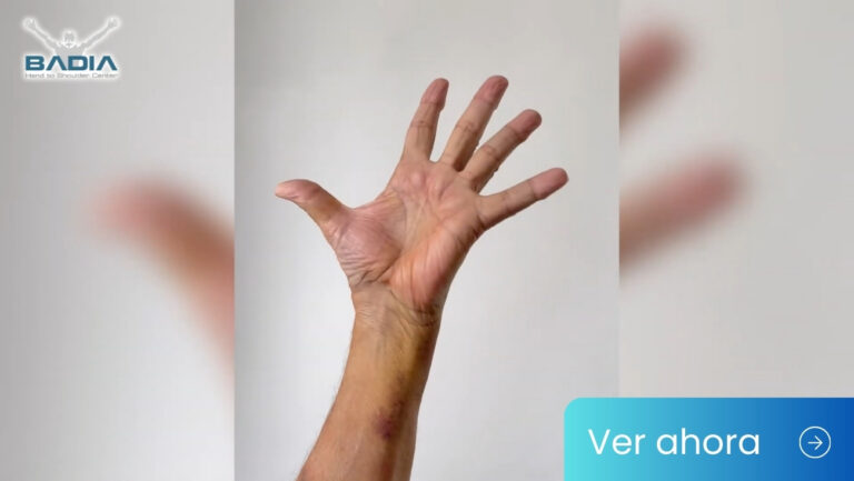 BioPro Prosthesis for Basal Joint Arthritis