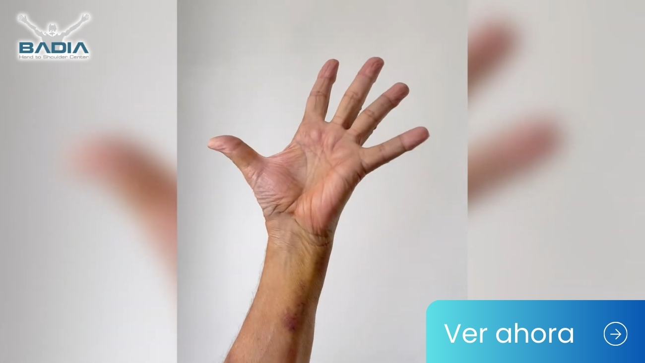 BioPro Prosthesis for Basal Joint Arthritis