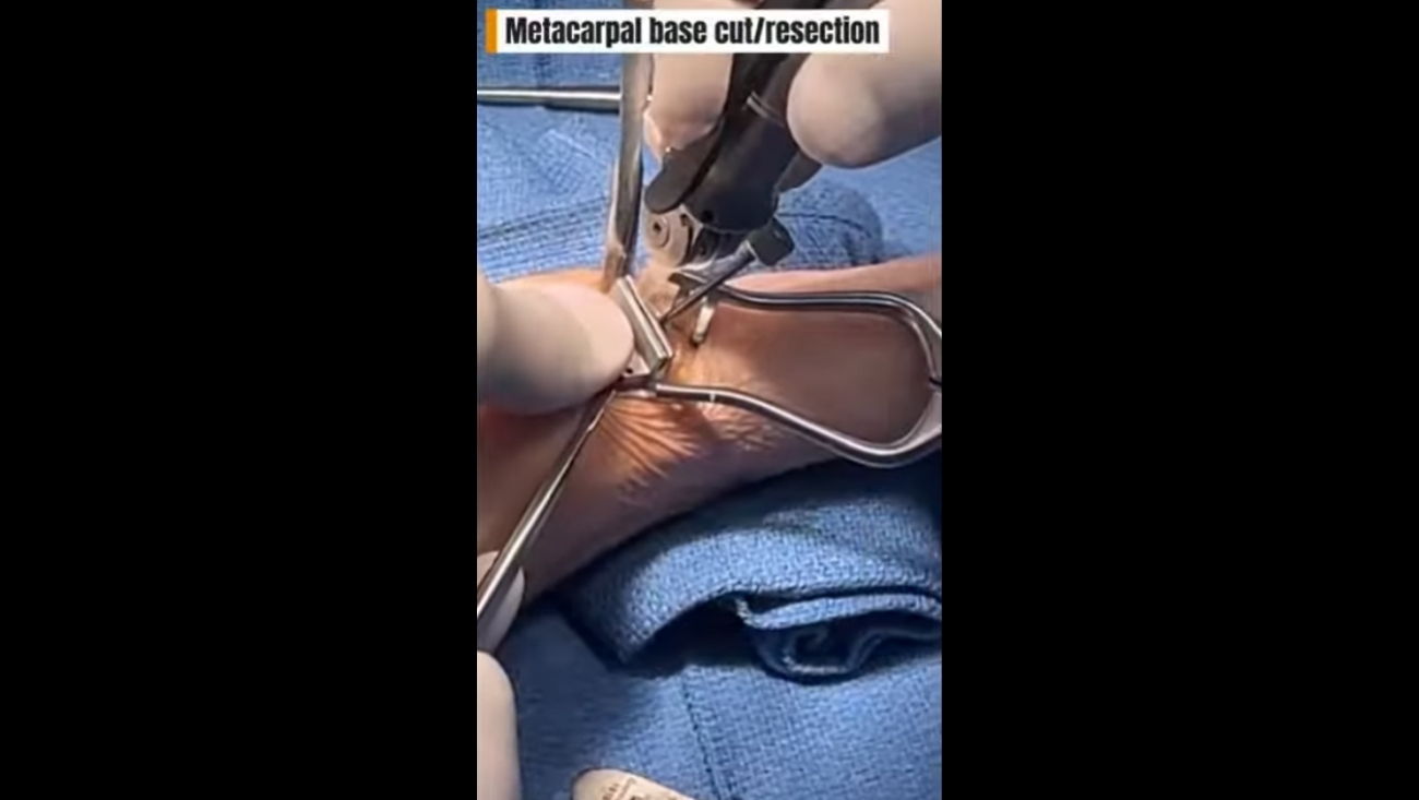 Double Hand Surgery: Thumb Joint Replacement & Finger Fusion