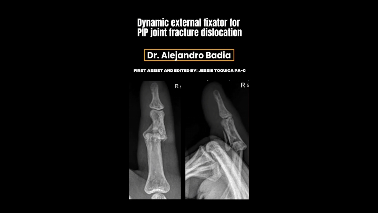 Dynamic External Fixator for PIP Joint Fracture Dislocation