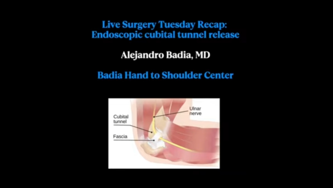 Endoscopic Cubital Tunnel Release: Surgery Recap & Patient Testimonial
