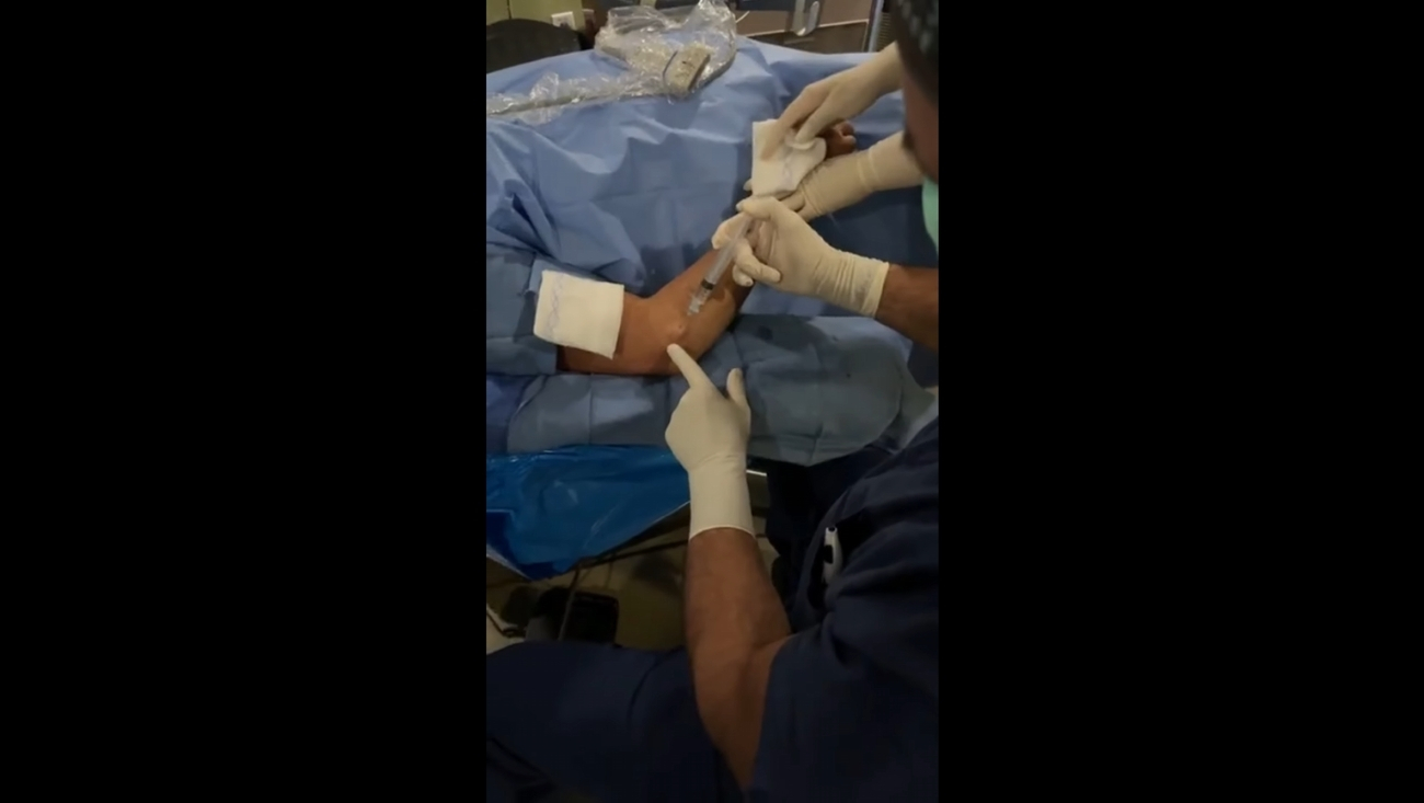 Tenex for Lateral Epicondylitis: Minimally Invasive Tennis Elbow Treatment