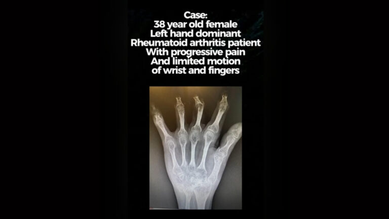 When Surgery Doesn't Go as Planned: Rheumatoid Arthritis & PIP Fusion
