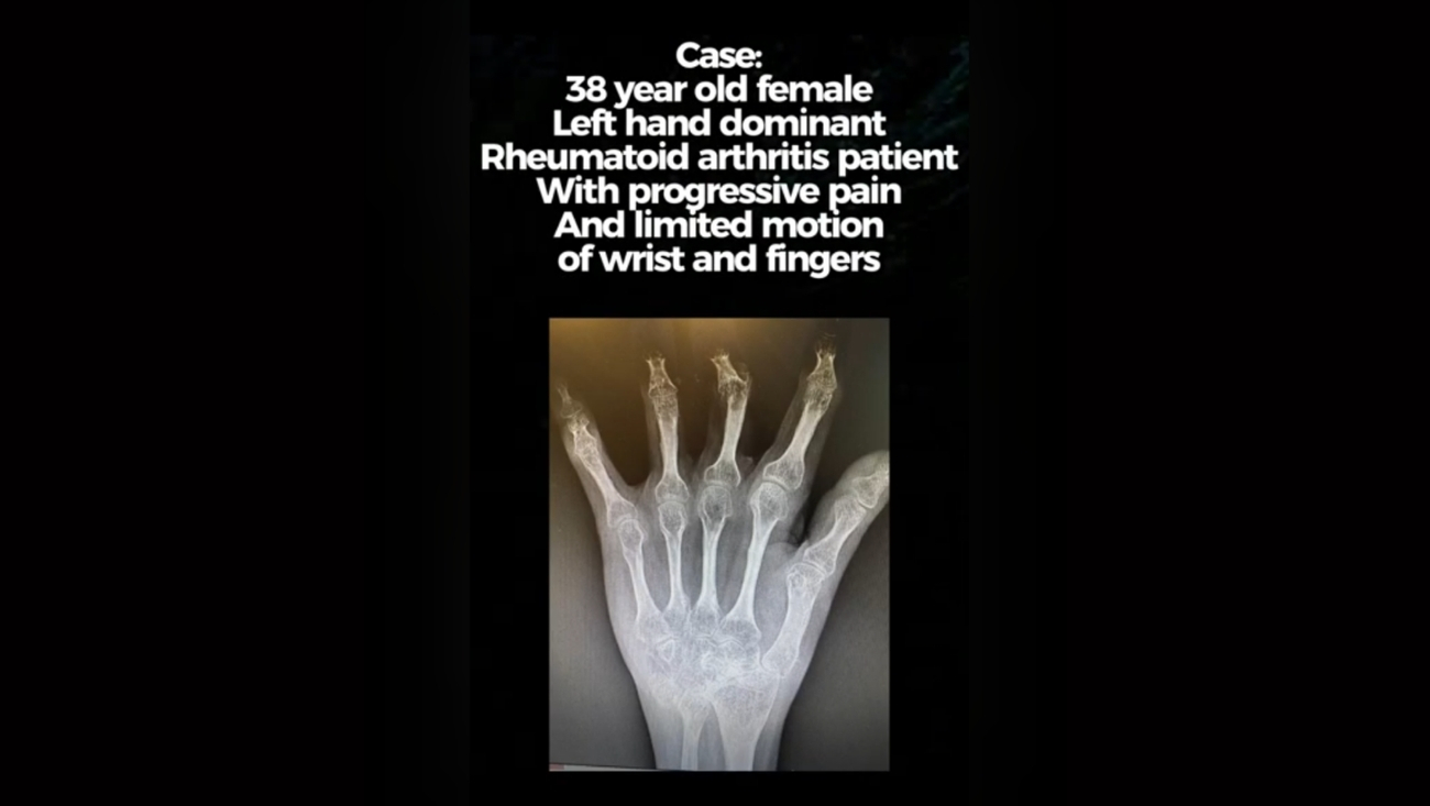 When Surgery Doesn’t Go as Planned: Rheumatoid Arthritis & PIP Fusion