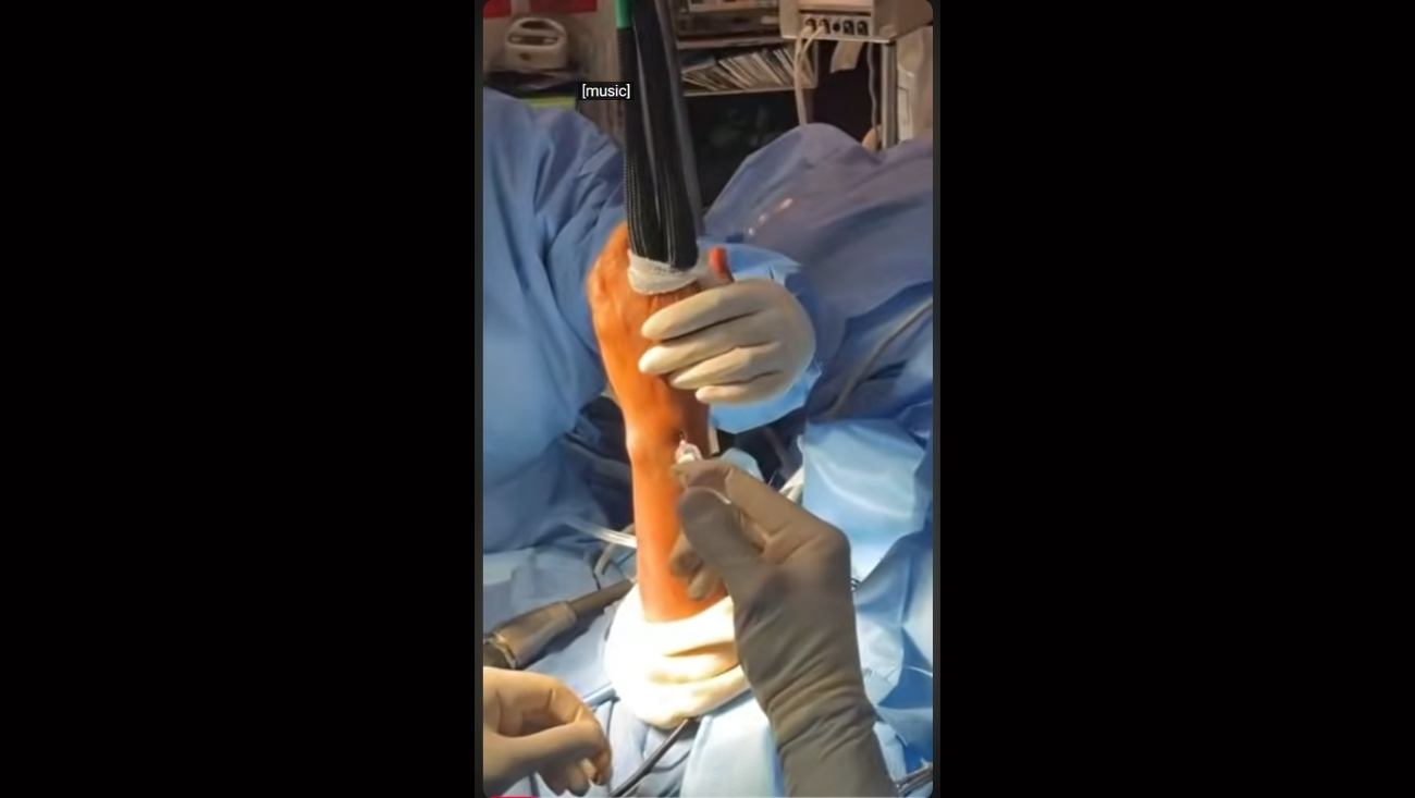 Complex Scapholunate Wrist Ligament Repair: 6-Week Recovery Story