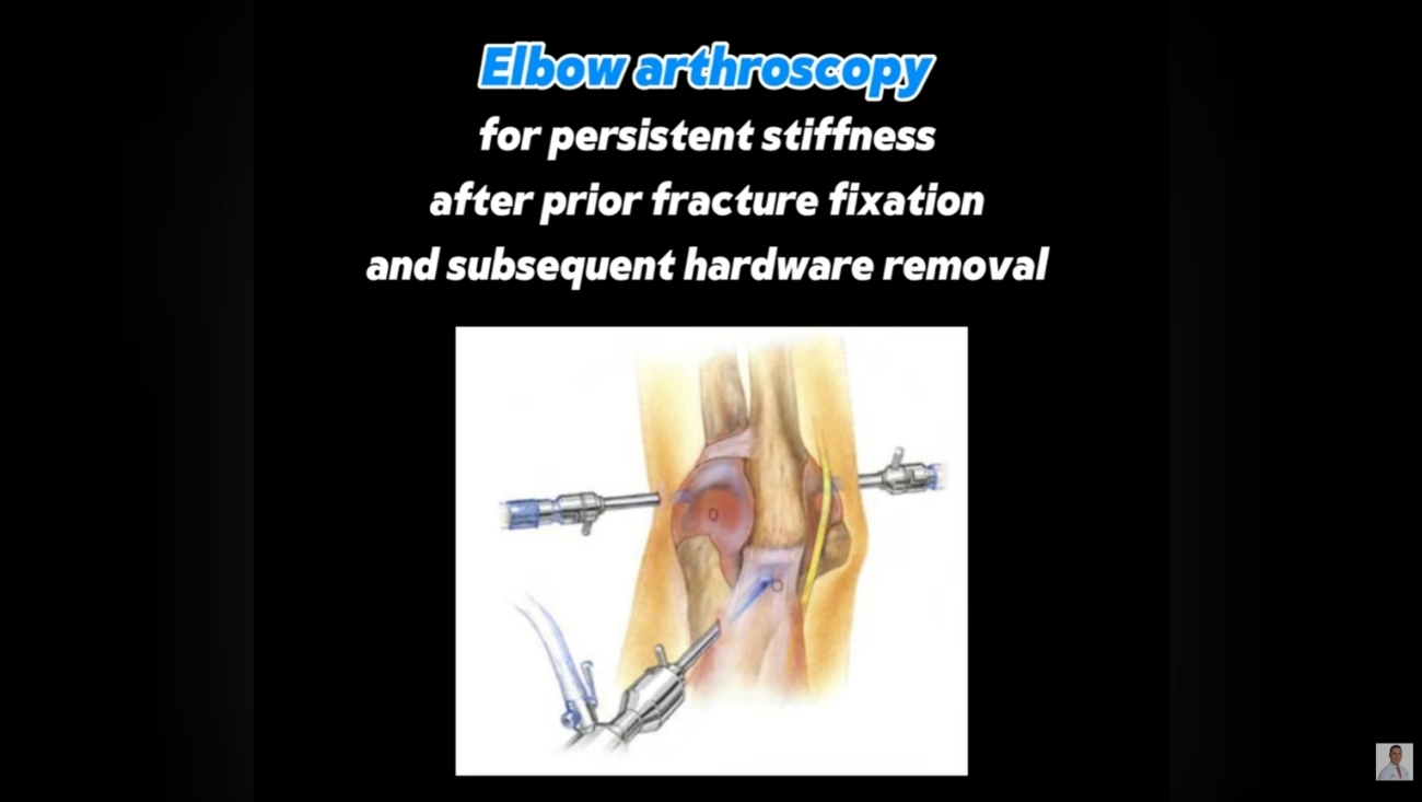 Elbow Arthroscopy & Tenex Procedure: Advanced Solution for Stiffness and Tennis Elbow