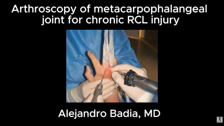 Intraoperative Correction of Claw Hand Deformity | Dr. Alejandro Badia