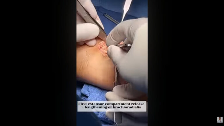 ORIF Surgery for Distal Radius Fracture: Precision Wrist Reconstruction