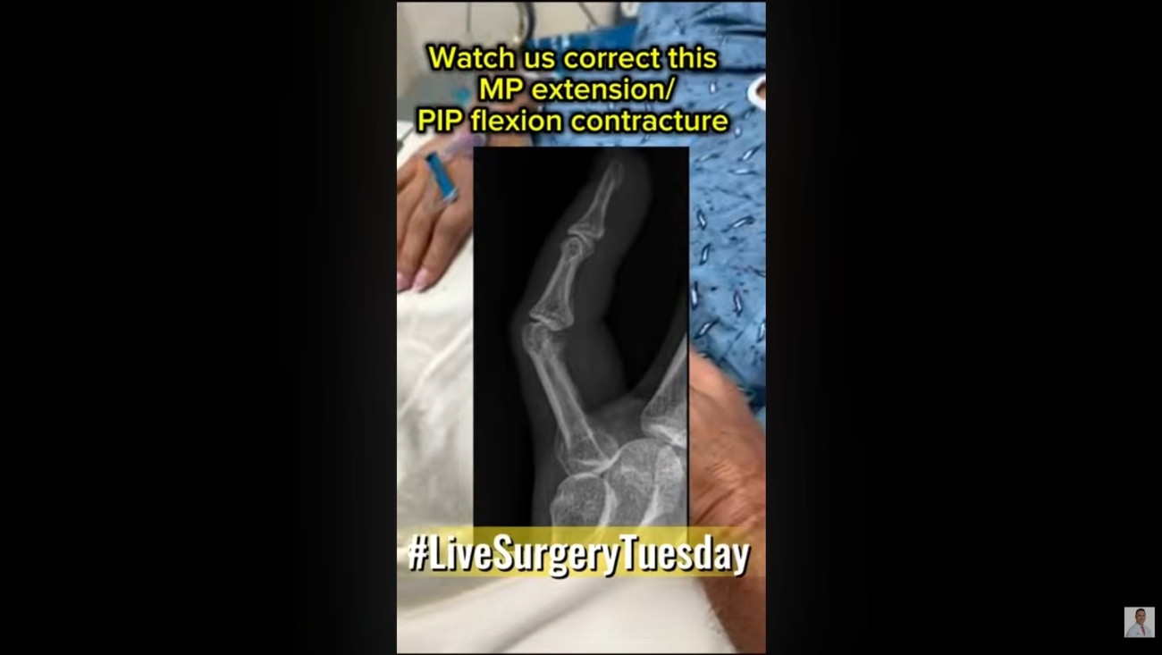 Rheumatoid Arthritis & Complex Multi-Joint Hand Reconstruction