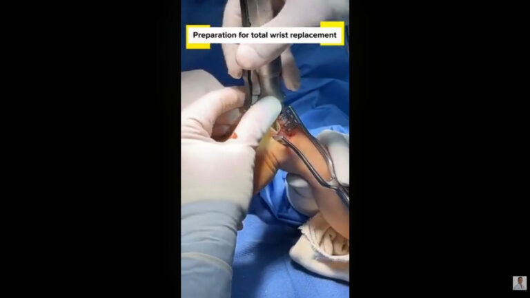 When Surgery Doesn't Go as Planned: Rheumatoid Arthritis & PIP Fusion