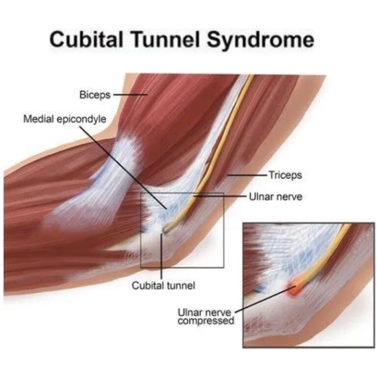 Cubital Tunnel Syndrome