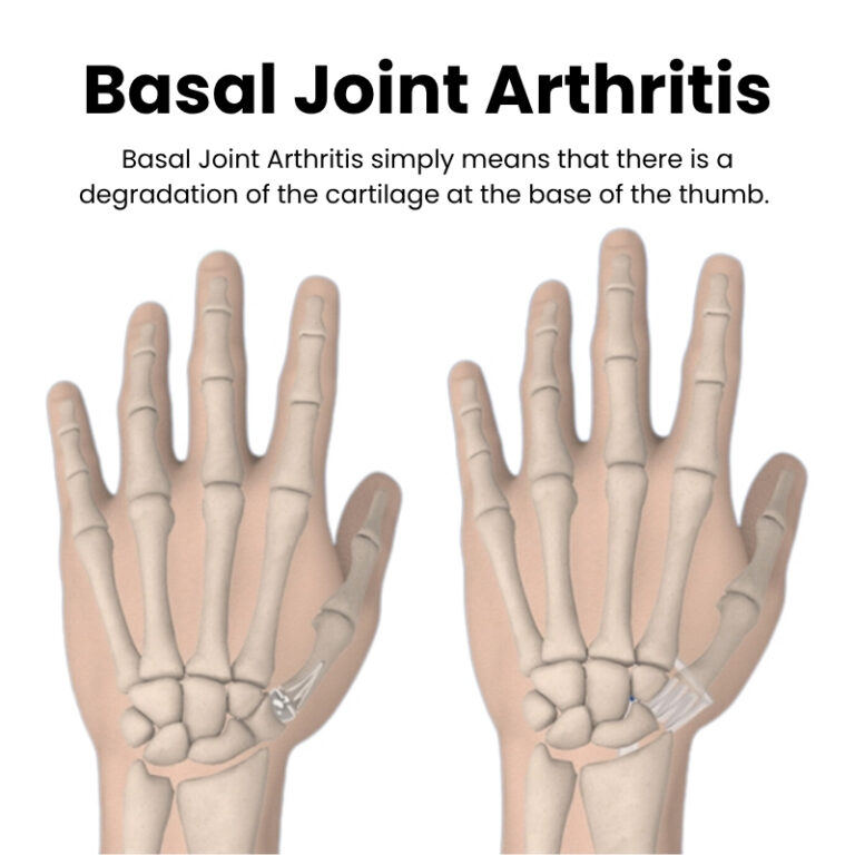 Basal Joint Arthritis
