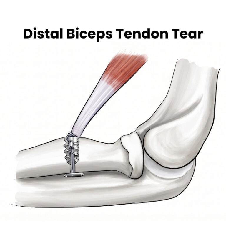Distal Biceps Tendon Tear