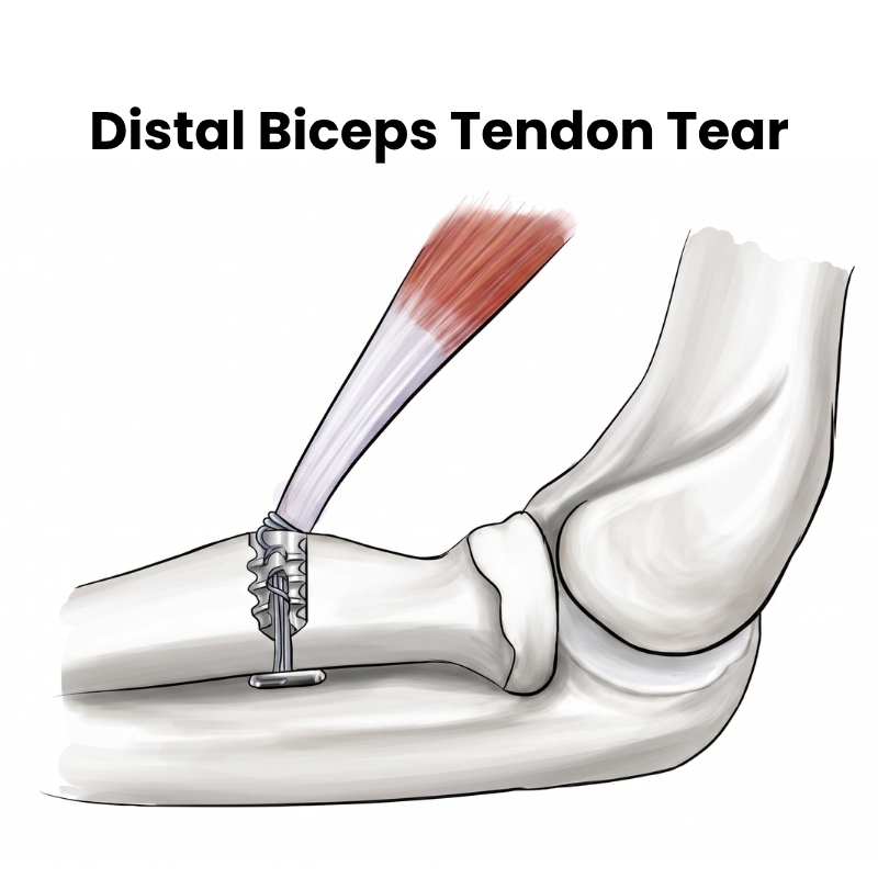 Distal Biceps Tendon Tear