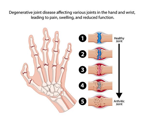 Finger Arthritis