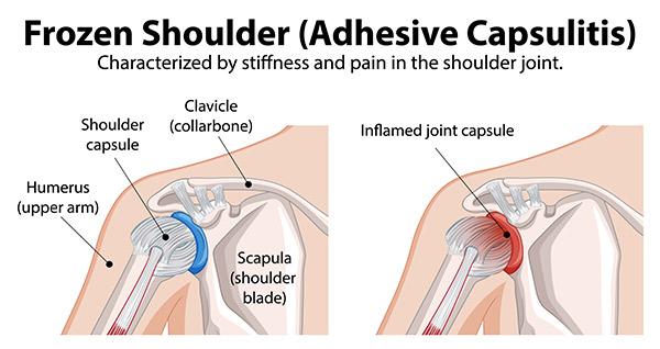 Frozen Shoulder