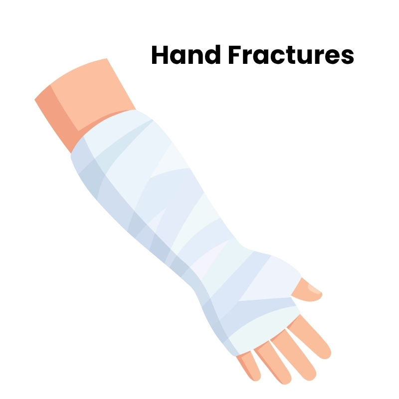 Hand Fractures