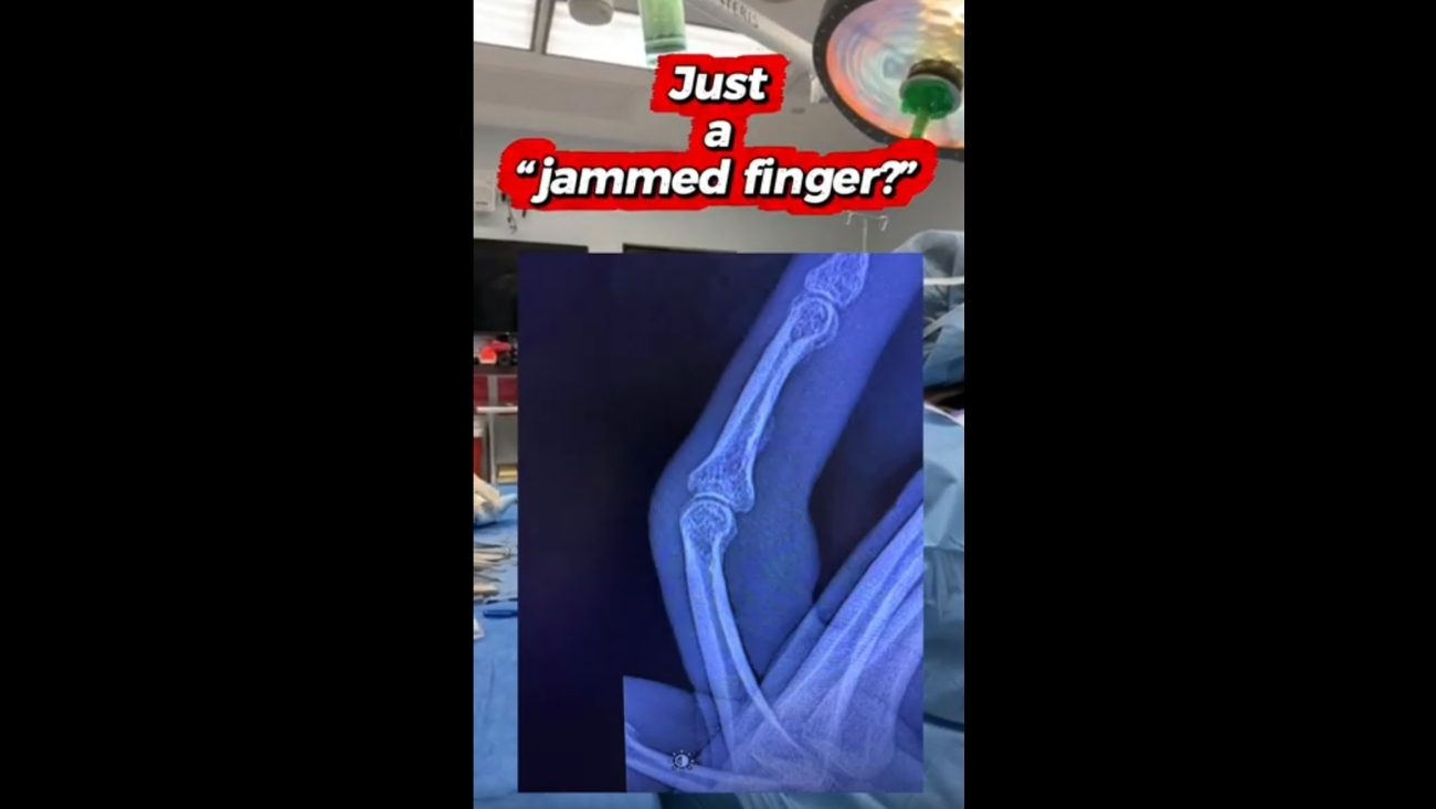 #Livesurgerytuesday Recap: This Is The Result Of Under Treatment Of A “Jammed Finger”